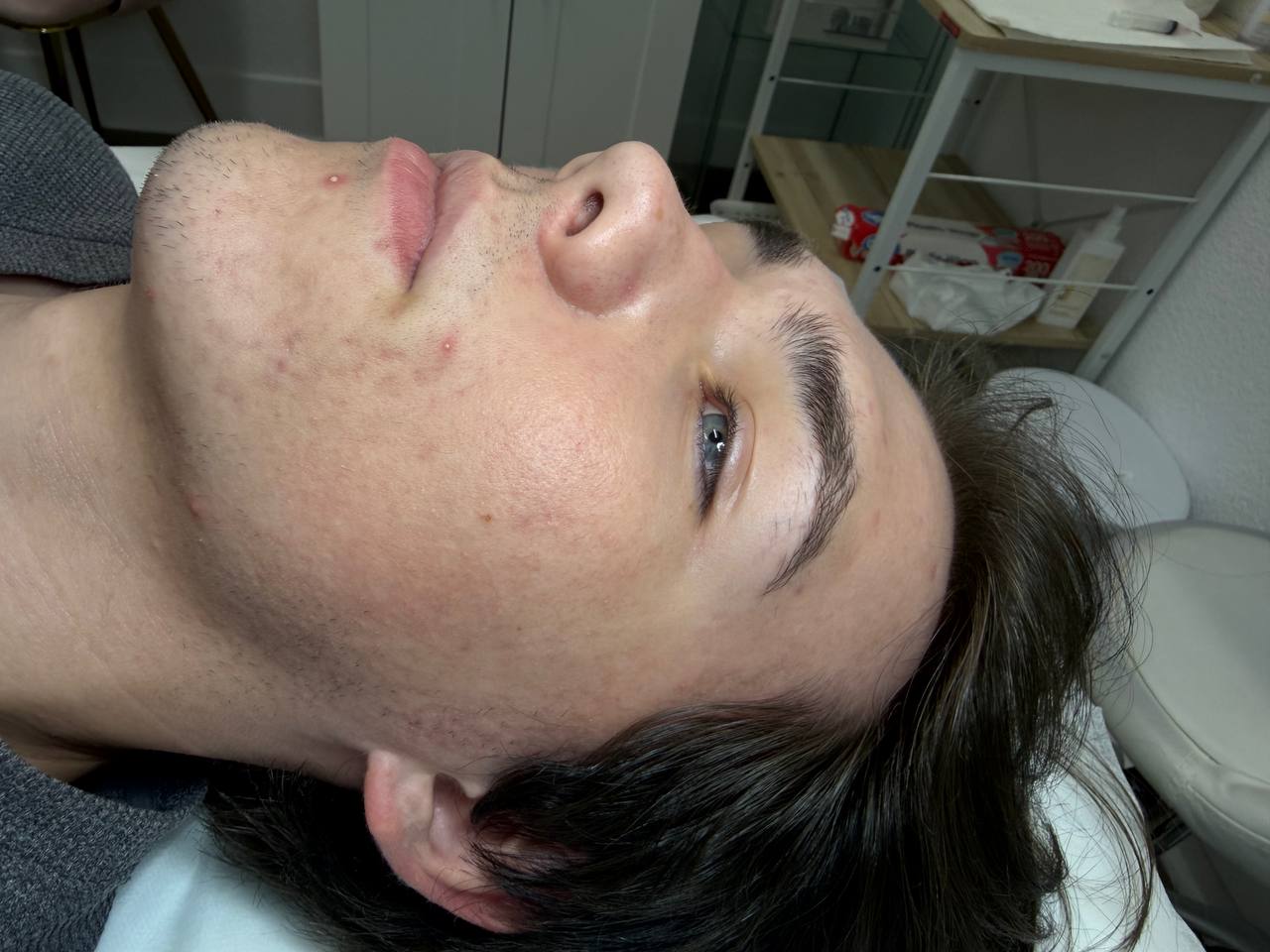Acne clearing treatment in progress at H.A. Skin Lab