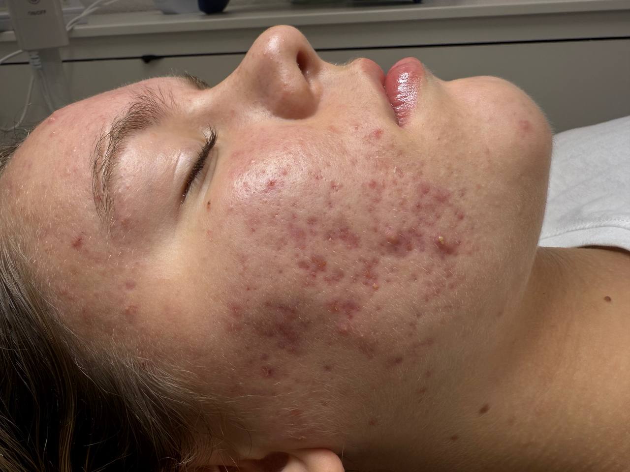 Skin analysis during an acne session