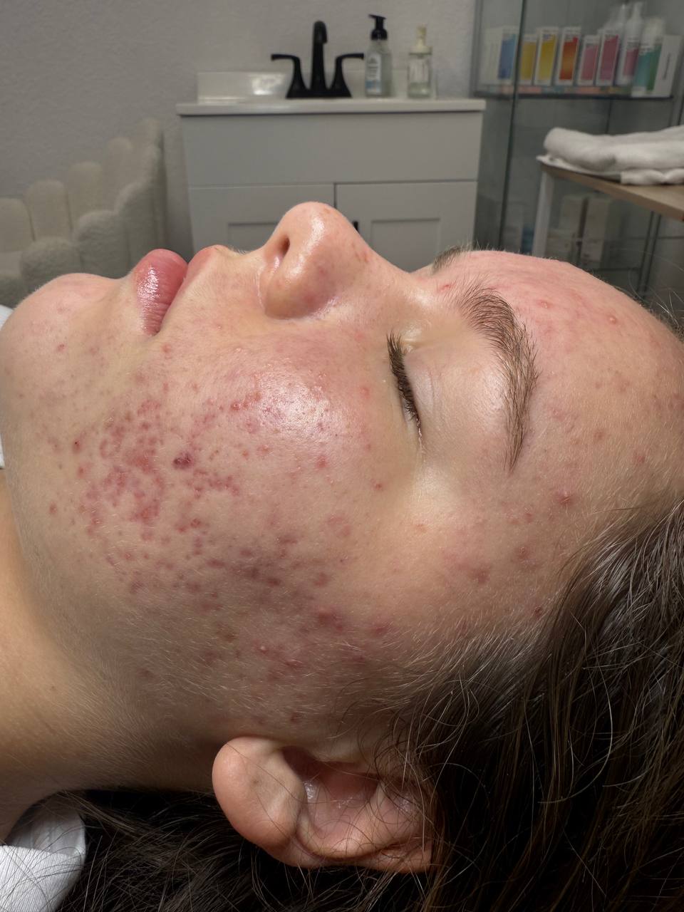 Extractions during a clearing treatment