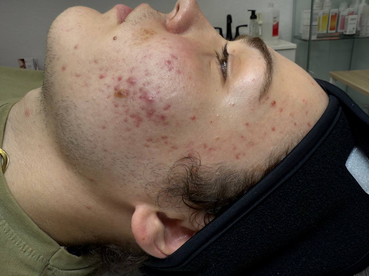 Skin at H.A. Skin Lab, treatment photo