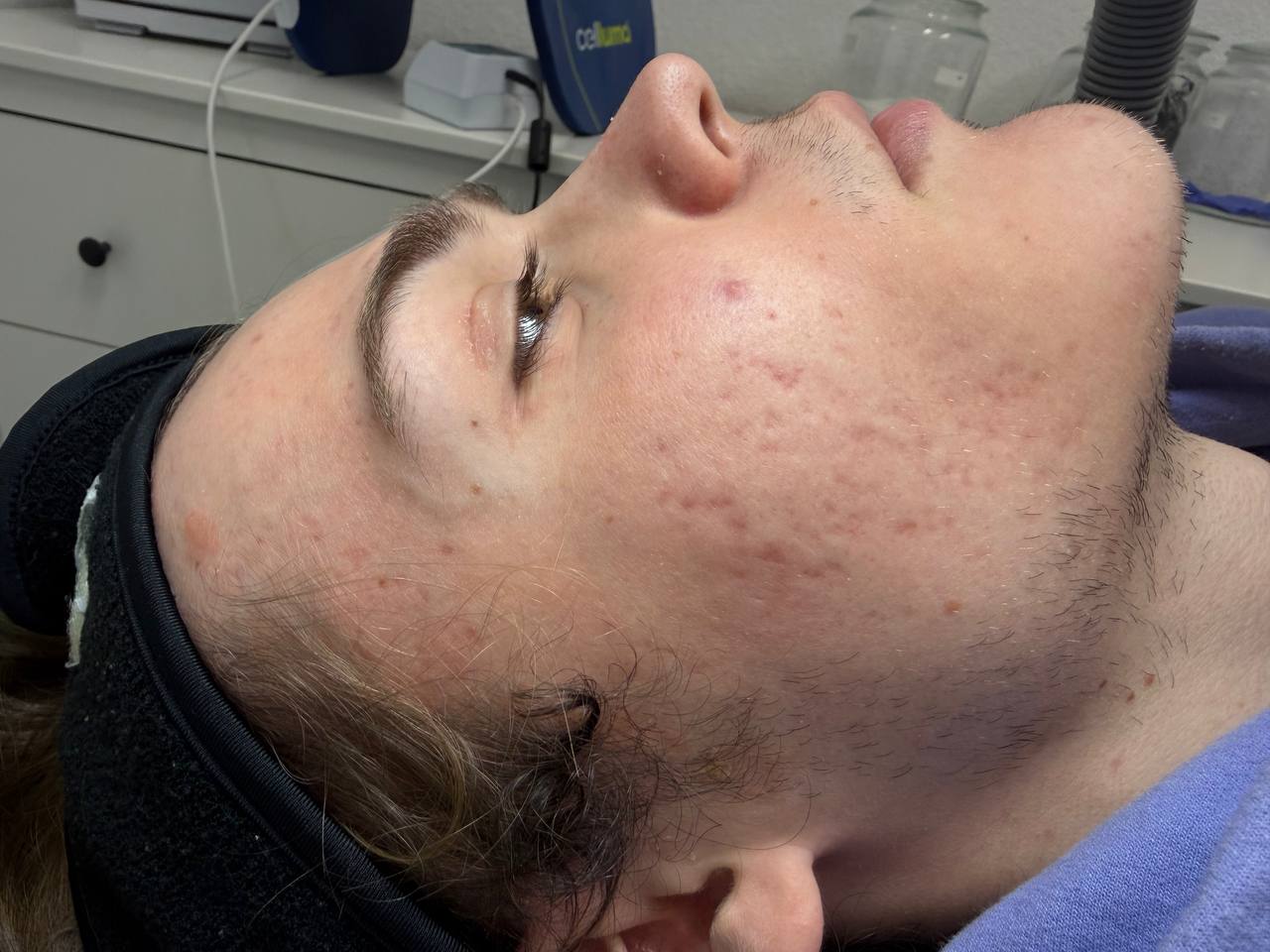 Post-treatment skin at H.A. Skin Lab