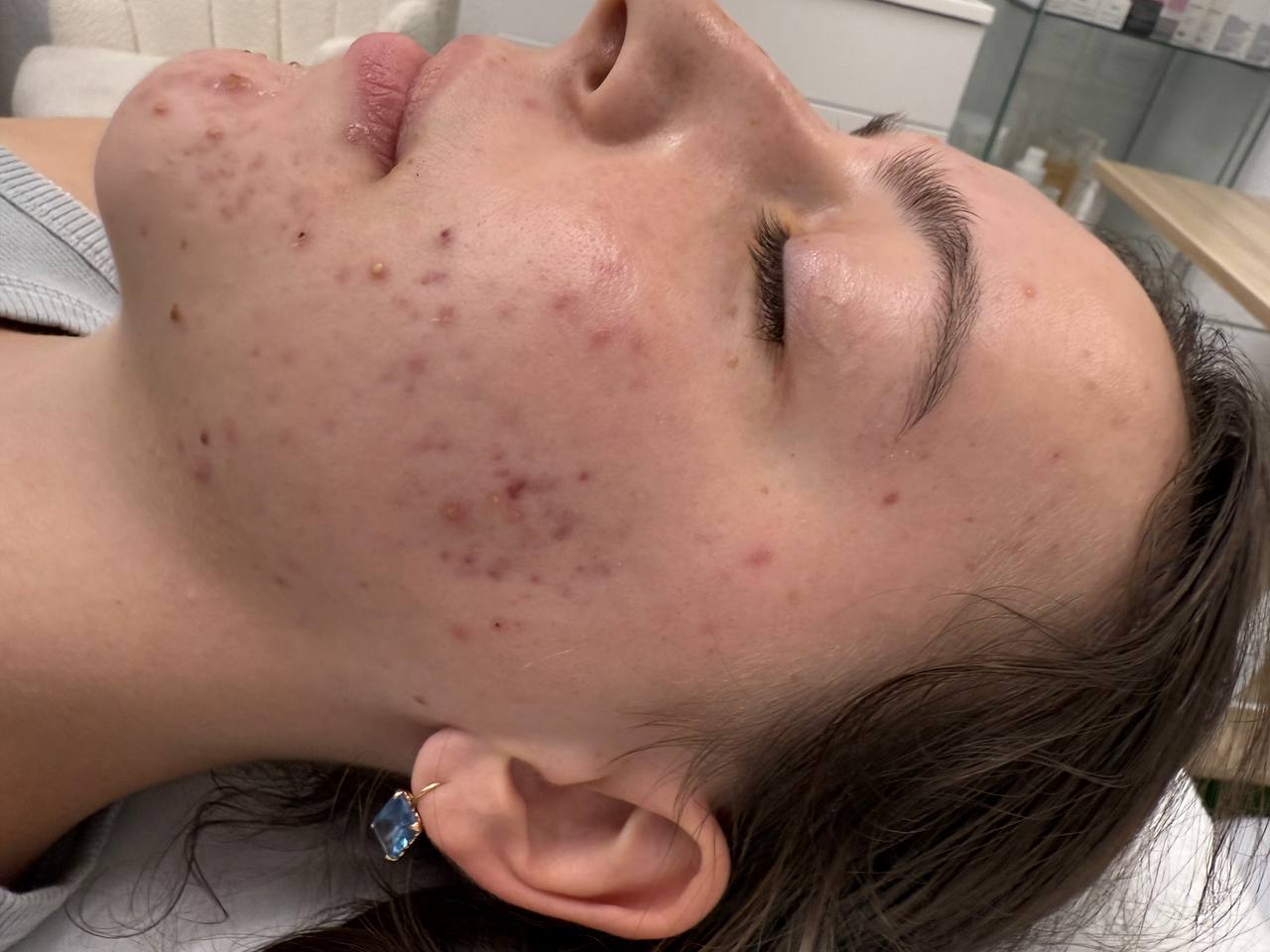 Acne treatment session at the Roseville studio