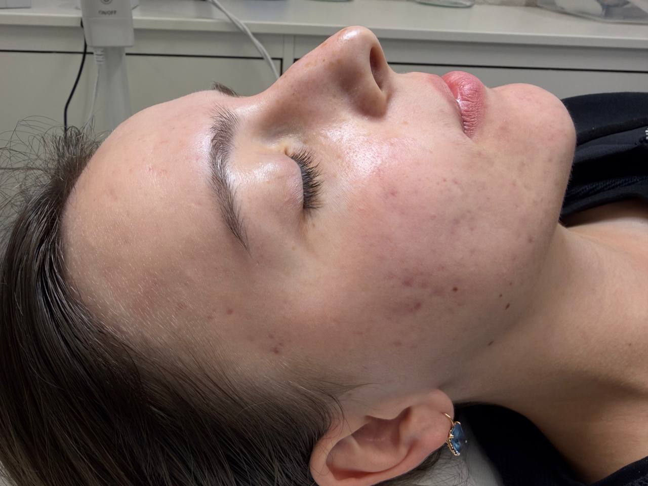 Skin health treatment in progress