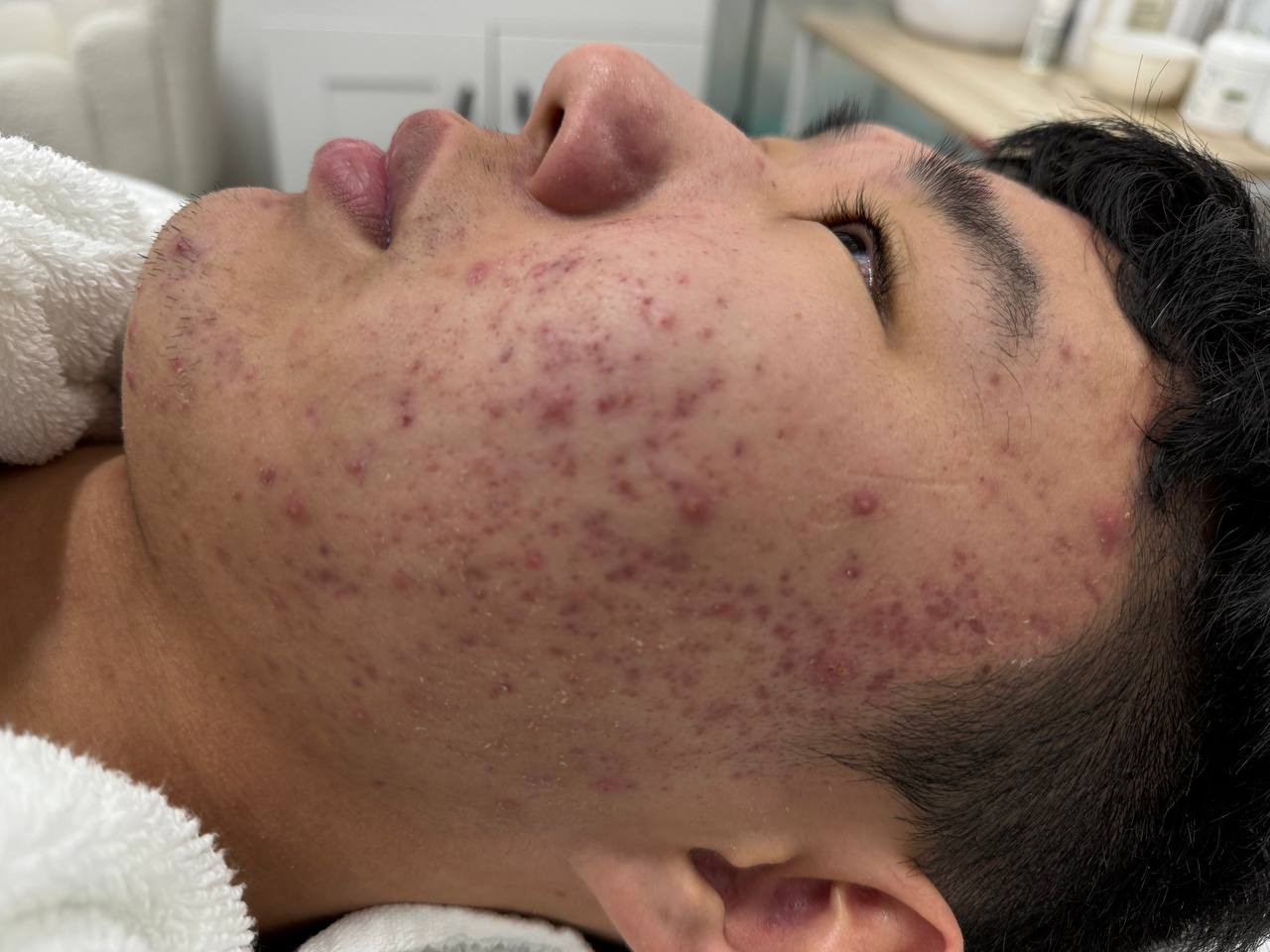 Treatment for congested, acne-prone skin