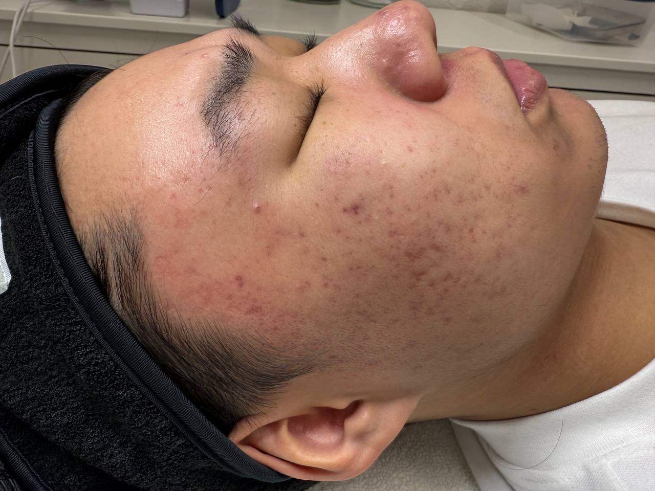 Skin at H.A. Skin Lab, treatment photo