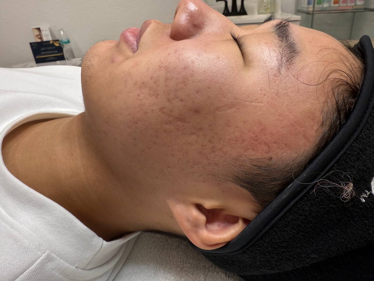 Barrier repair facial in progress