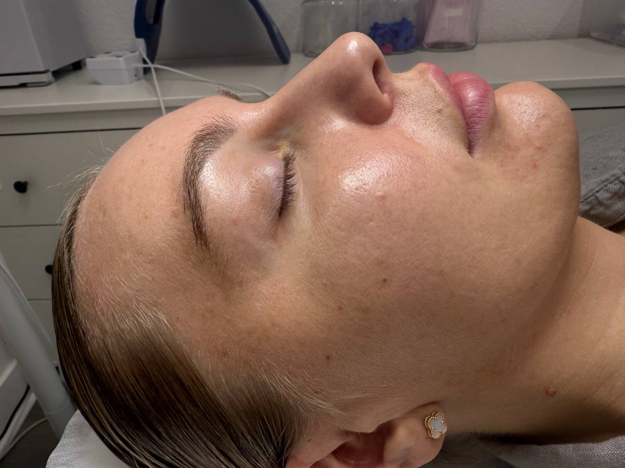 Skin responding after a clearing protocol