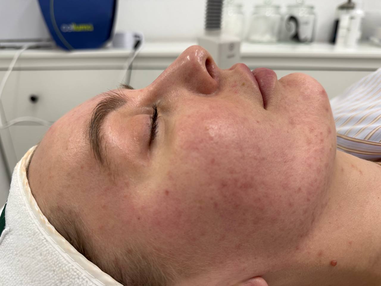 Clearer skin during an ongoing protocol