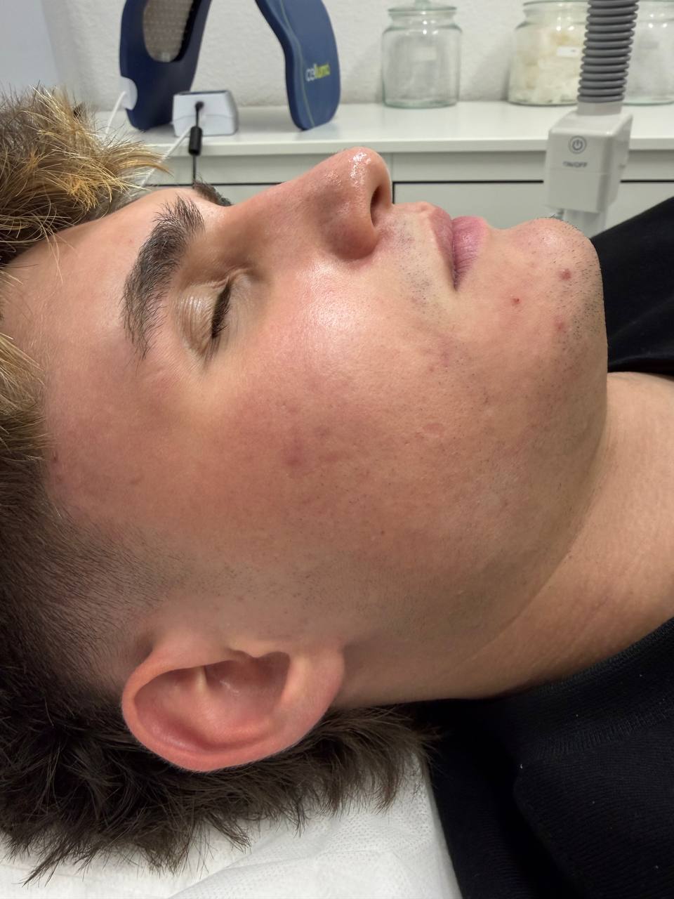 Treatment session for inflammatory acne